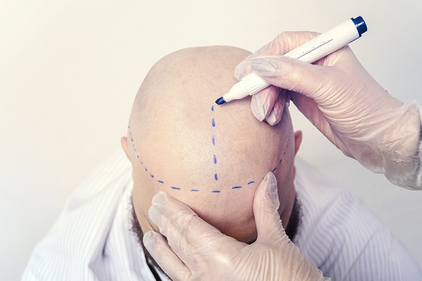 trasplante cabello, un especialista divide con una línea en dos la cabeza a la altura del cabello, de un paciente calvo; para poder realizar el proceso