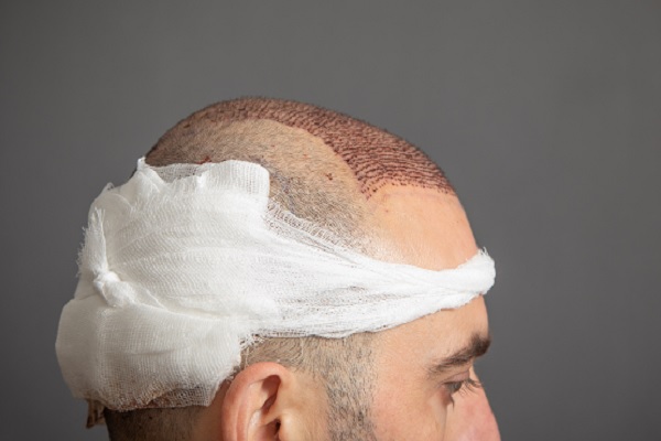 trasplante de cabello, un hombre de perfil inmediatamente después del procedimiento de implante capilar