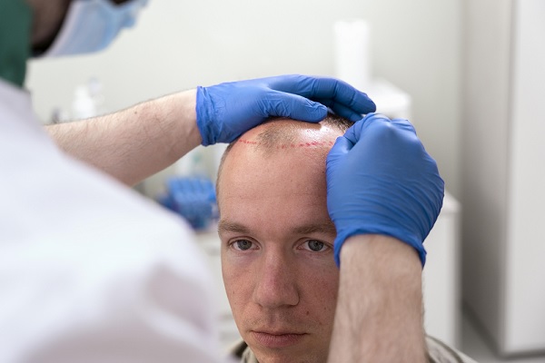 trasplante de cabello, un especialista marca la línea del cabello en un hombre calvo