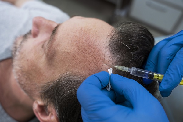 trasplante de cabello, un especialista le implanta cabello a un paciente