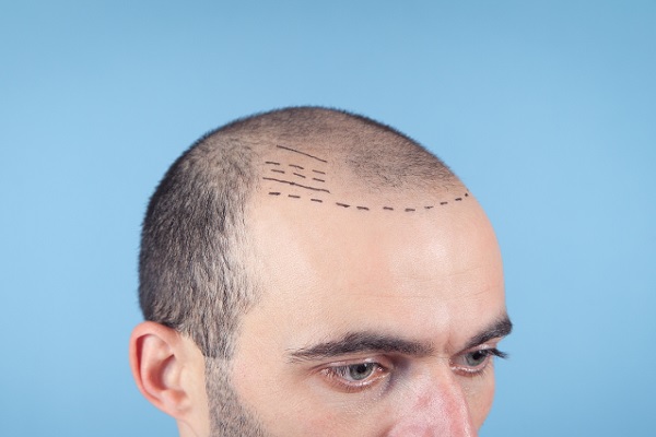 trasplante de cabello - hombre calvo con las entradas marcadas listo para su procedimiento de implante capilar