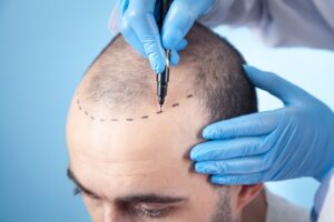 injerto capilar, un tricólogo marca la zona de las entradas de cabello a paciente con alopecia