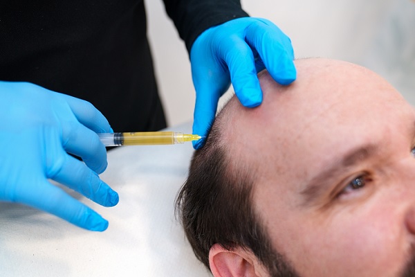 un especialista le inyecta PRP en el cuero cabelludo para sanar para estimular el crecimiento del cabello