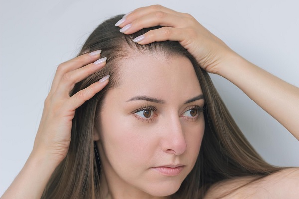 calvicie en mujeres - Mujer que sufre de pérdida de cabello en el área frontal de su cabeza