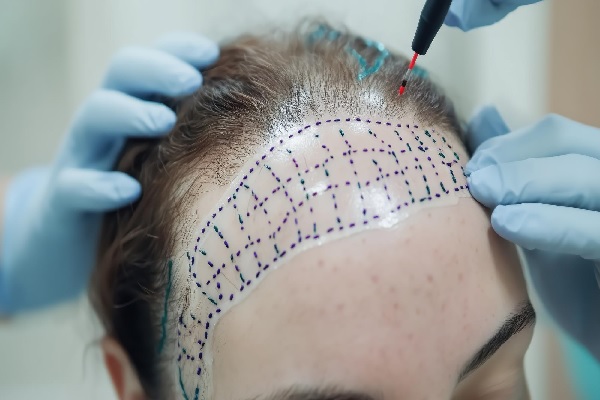 mejor clínica de trasplante capilar - mujer con la zona de la frente marcada para realizar un implante capilar, utilizando técnica adecuada para su caso